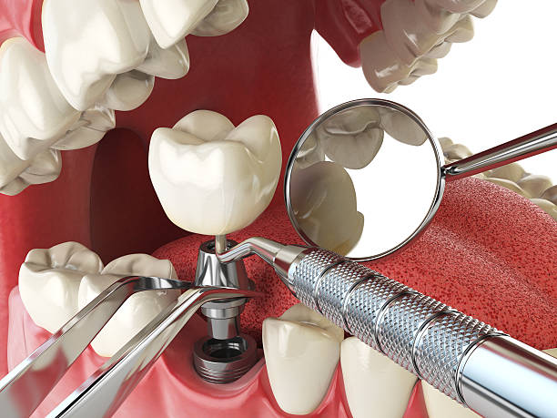Best Emergency Tooth Extraction in Brea, CA